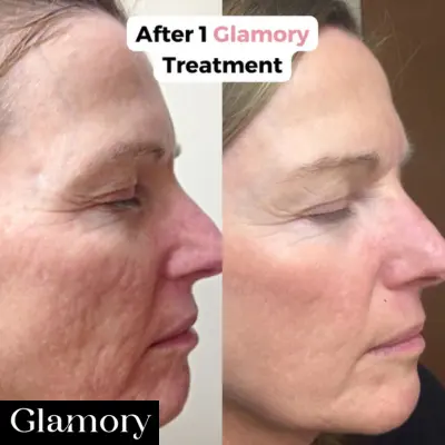 Glamory Micro Infusion Reviews