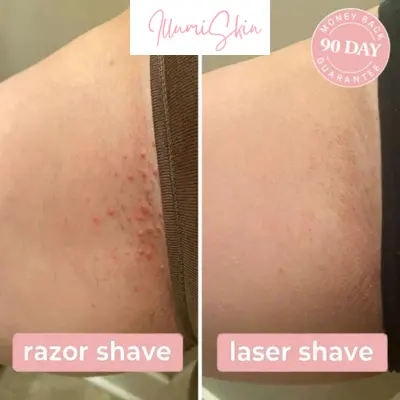 Illumi Hair Removal Reviews