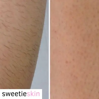 Sweetie Skin Hair Removal Reviews